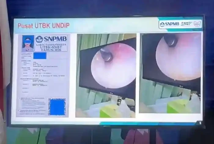 Salah satu modus kecurangan dalam UTBK-SNBT 2026 di Universitas Diponegoro (Undip) dengan menanamkan alat bantu dengar di liang telinga.